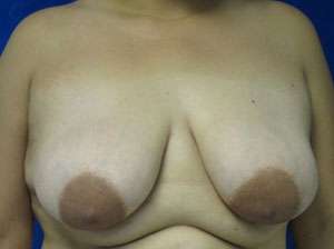 Breast Lift Before & After Patient #7893