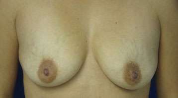Breast Lift Before & After Patient #7899
