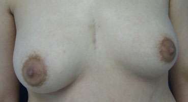 Breast Lift Before & After Patient #7902