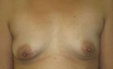 Breast Lift Before & After Patient #7905