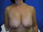 Breast Lift Before & After Patient #7908