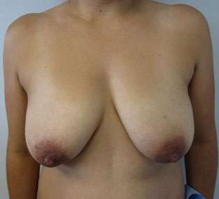 Breast Lift Before & After Patient #7911