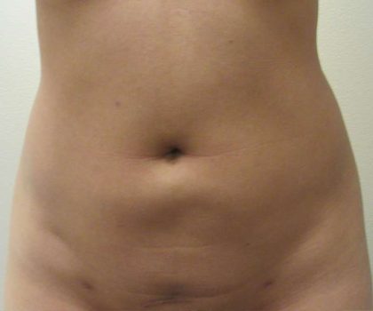 Bodytite Before & After Patient #6075