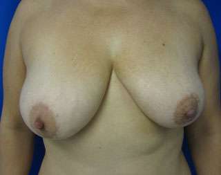 Breast Lift Before & After Patient #7917