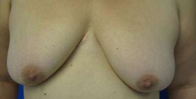 Breast Lift Before & After Patient #7920