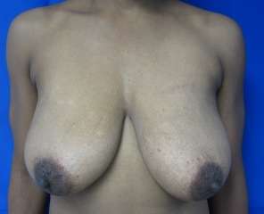 Breast Lift Before & After Patient #7927