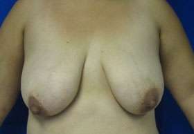 Breast Lift Before & After Patient #7930