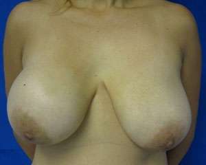 Breast Lift Before & After Patient #7933