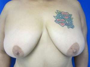 Breast Lift Before & After Patient #7936