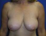 Breast Lift Before & After Patient #7942