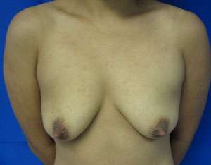 Breast Reconstruction and Breast Deformity Correction Before & After Patient #7945