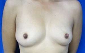 Breast Reconstruction and Breast Deformity Correction Before & After Patient #7948