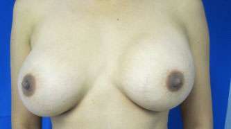 Breast Reconstruction and Breast Deformity Correction Before & After Patient #7954