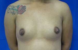Breast Reconstruction and Breast Deformity Correction Before & After Patient #7960