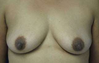 Breast Reconstruction and Breast Deformity Correction Before & After Patient #7963
