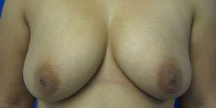 Breast Reconstruction and Breast Deformity Correction Before & After Patient #7981