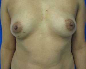 Breast Reconstruction and Breast Deformity Correction Before & After Patient #7987