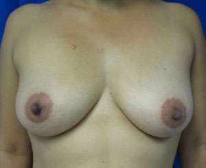 Breast Reconstruction and Breast Deformity Correction Before & After Patient #7999