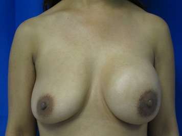 Breast Reconstruction and Breast Deformity Correction Before & After Patient #8002