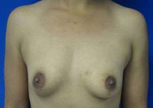 Breast Reconstruction and Breast Deformity Correction Before & After Patient #8005