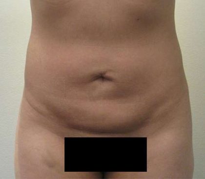 Bodytite Before & After Patient #6086