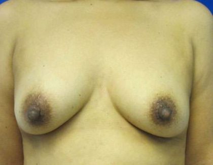 Breast Reconstruction and Breast Deformity Correction Before & After Patient #8008