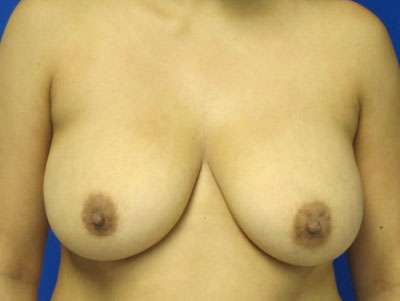 Breast Reconstruction and Breast Deformity Correction Before & After Patient #8011