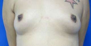 Breast Reconstruction and Breast Deformity Correction Before & After Patient #8020