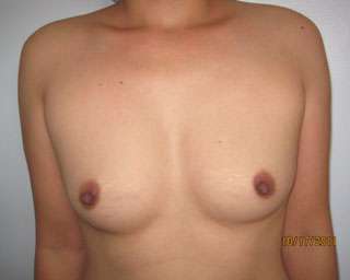 Breast Reconstruction and Breast Deformity Correction Before & After Patient #8023