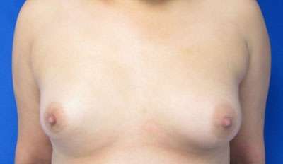 Breast Reconstruction and Breast Deformity Correction Before & After Patient #8029