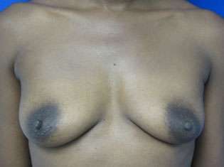 Breast Reconstruction and Breast Deformity Correction Before & After Patient #8035