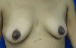 Breast Reconstruction and Breast Deformity Correction Before & After Patient #8041