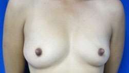 Breast Reconstruction and Breast Deformity Correction Before & After Patient #8047