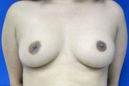 Breast Reconstruction and Breast Deformity Correction Before & After Patient #8050