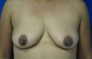 Breast Reconstruction and Breast Deformity Correction Before & After Patient #8053