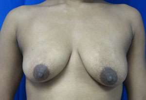 Breast Reconstruction and Breast Deformity Correction Before & After Patient #8059
