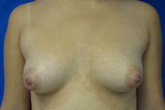 Breast Reconstruction and Breast Deformity Correction Before & After Patient #8062