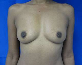 Breast Reconstruction and Breast Deformity Correction Before & After Patient #8071