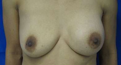 Breast Reconstruction and Breast Deformity Correction Before & After Patient #8089