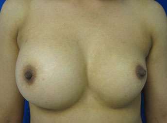 Breast Reconstruction and Breast Deformity Correction Before & After Patient #8092