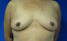 Breast Reconstruction and Breast Deformity Correction Before & After Patient #8098
