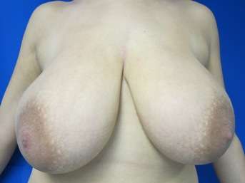 Breast Reduction Before & After Patient #8101