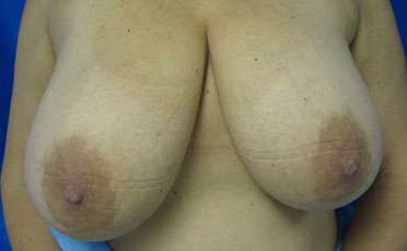 Breast Reduction Before & After Patient #8104