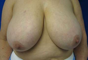 Breast Reduction Before & After Patient #8110