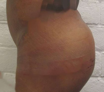 Butt Implants Before & After Patient #8137