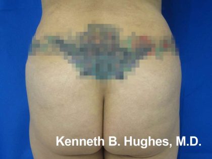 Butt Implants Before & After Patient #8147