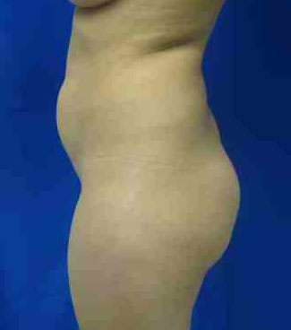 Butt Implants Before & After Patient #8153