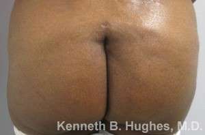 Butt Implants Before & After Patient #8165