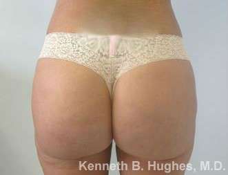 Butt Implants Before & After Patient #8168
