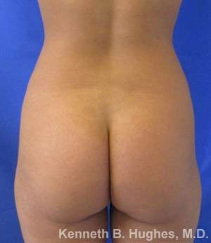 Butt Implants Before & After Patient #8173